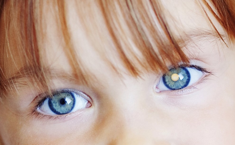 Voir le blanc - diagnostic précoce pour le retinoblastome